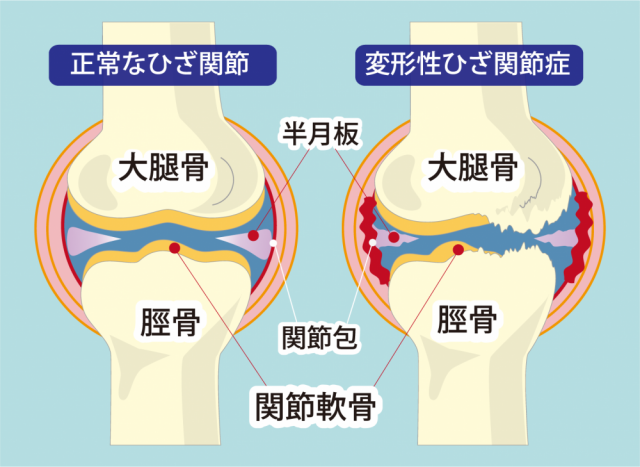 膝の関節イラスト